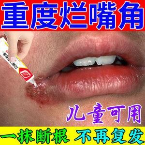 嘴皮伤了用什么药（嘴皮有伤口用什么药）-图1