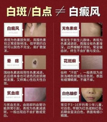 包含白癜风病可以吃葡萄吗的词条-图2