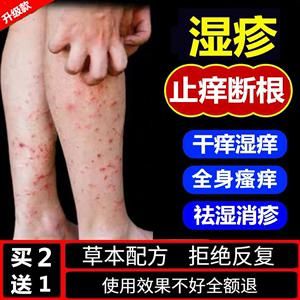 腿上皮肤痒用什么药（腿上瘙痒用什么药）-图3