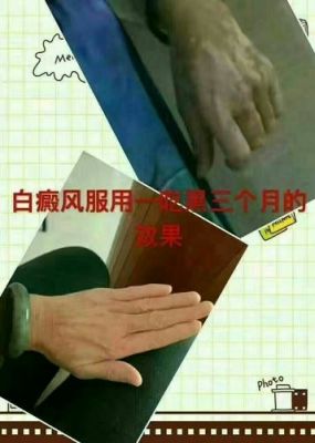 一吃黑能治疗白癜风吗（一吃黑真的有效果吗）-图1