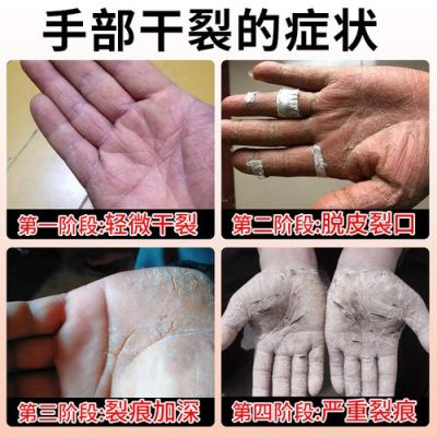 治裂手的药叫什么药（治裂手的药叫什么药膏）-图3