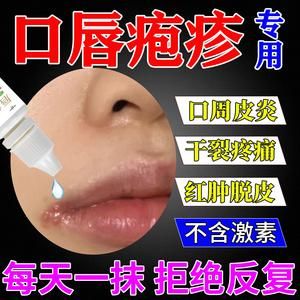 腺性唇炎涂什么药（腺性唇炎能治好吗）