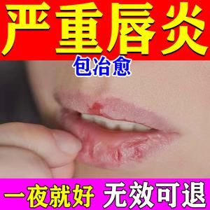 腺性唇炎涂什么药（腺性唇炎能治好吗）-图2