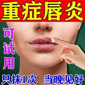 腺性唇炎涂什么药（腺性唇炎能治好吗）-图3