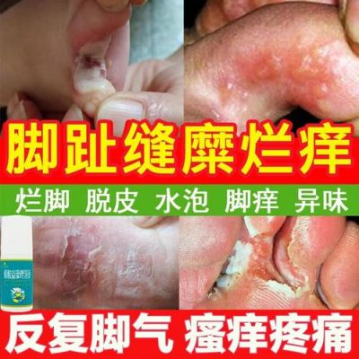 脚臭脚趾缝烂用什么药（脚趾缝溃烂发臭擦什么药）-图2