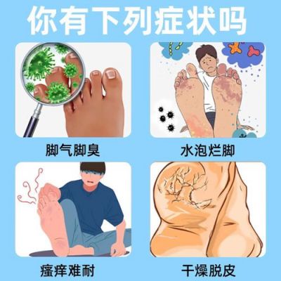 脚臭脚趾缝烂用什么药（脚趾缝溃烂发臭擦什么药）-图3