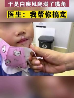 小孩吃辣条吃出白癜风的故事（小孩吃辣条会得白血病吗）-图2