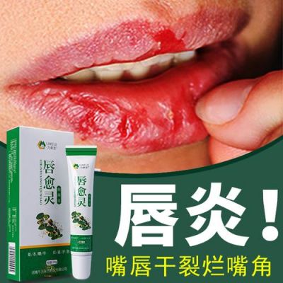 嘴巴裂开了用什么药（嘴角有口子,一张嘴就裂,怎么才能好）-图2