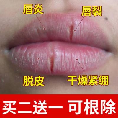 嘴巴裂开了用什么药（嘴角有口子,一张嘴就裂,怎么才能好）-图1