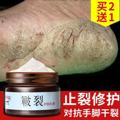 足脱皮要用什么药（足脱皮用什么药膏）-图2