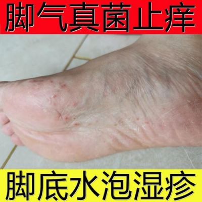 脚上起泡很痒用什么药（脚上起水泡很痒用什么药）-图1