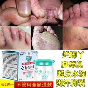 脚上有水泡用什么药（脚上有水泡用什么药膏擦）-图2