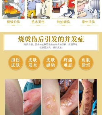 烧伤了怎么办涂什么药（烧伤了怎么办涂什么药膏）-图2