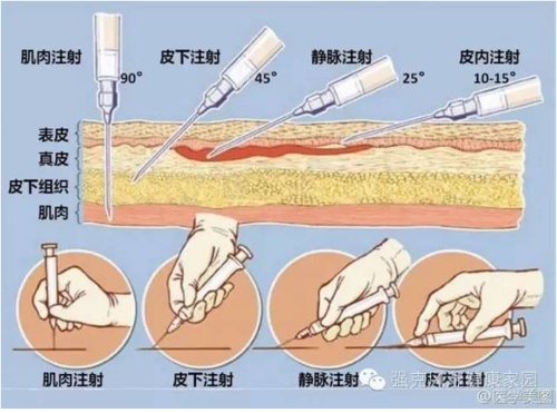 肌肉注射什么药治腿疼（肌肉注射腿部摆放位置）