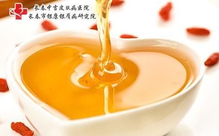 吃蜂蜜治疗白癜风吗（喝蜂蜜能治白头发吗）-图3