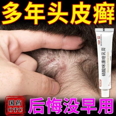 头藓用什么药（头藓用什么药品）-图2