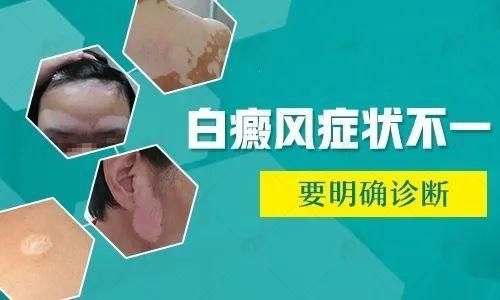 坚持吃维生素白癜风自愈的简单介绍-图3