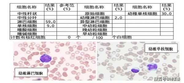 幼稚细胞吃什么药（幼稚细胞增多意味什么）-图3