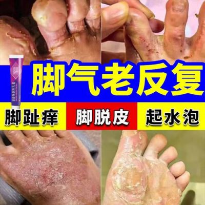 脚指头缝溃烂用什么药（脚指头缝溃烂用什么药好得快）-图1