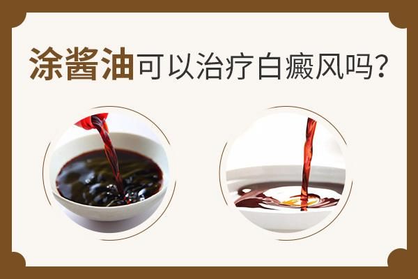 白癜风吃酱油可以吗（白斑能吃酱油吗）-图2