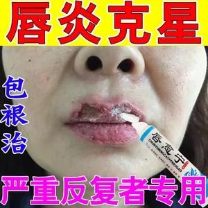 嘴唇发干发紫吃什么药（嘴唇发干发紫吃什么药调理）-图2