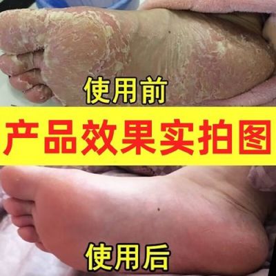 脚趾间溃烂用什么药（脚趾间溃烂怎么回事）-图2