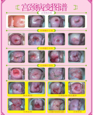 宫颈点药脱落什么（宫颈给药怎么会有点出血呢）-图1