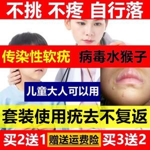 传染性软尤吃什么药（传染性软尤怎么根治）-图3