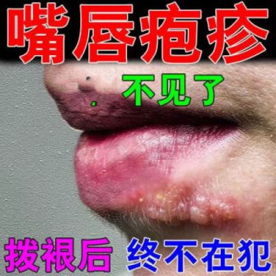 嘴角长水泡吃什么药好（嘴角长水泡吃什么药好得快一点）-图3