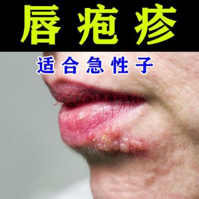 嘴角长水泡吃什么药好（嘴角长水泡吃什么药好得快一点）-图2