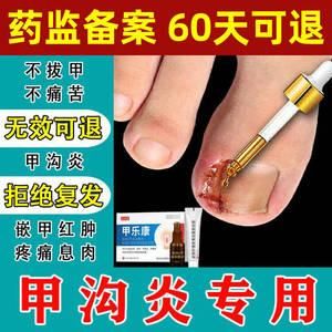 甲沟炎化脓敷什么药（甲沟炎化脓用什么药好大夫）-图3