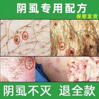 男士阴湿用什么药（治疗男性阴囊潮湿用啥药效果最好?）-图3