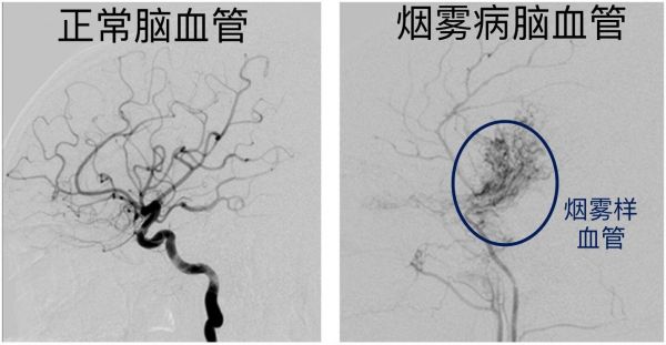 烟雾病用什么药（烟雾病用什么药治疗）-图2