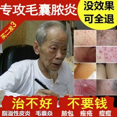 毛狼炎用什么药（毛狼炎症状）-图3