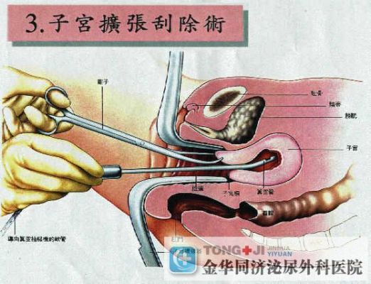 药流原理是什么意思（药流的机理和使用方法）-图1