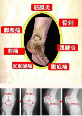 跟腱炎吃什么消炎药好（治疗跟腱炎消炎药有哪些比较好）-图3