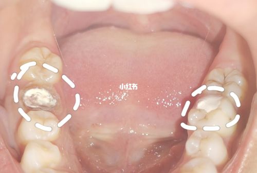 补牙封药两周是的什么药（补牙封药几天后才能补）-图3