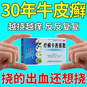 什么药治牛皮癣（牛皮皮癣用什么药治疗效果好）-图2