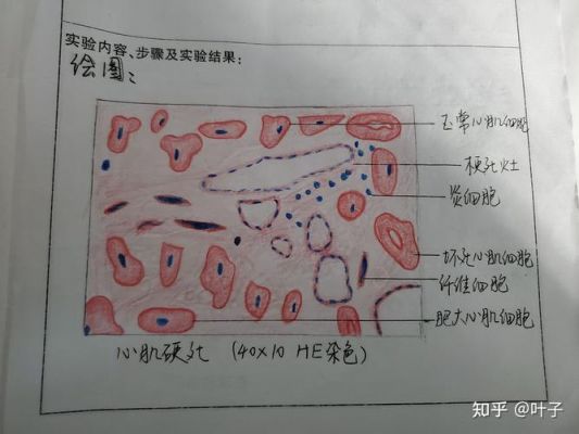 脾梗塞吃什么药（脾梗塞能自愈吗）-图2