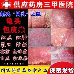 包皮龟头炎用什么药擦的简单介绍-图2