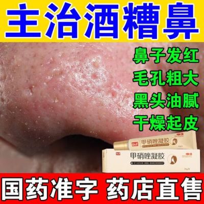 青春痘酒刺用什么药（青春痘能不能用酒精擦）-图2