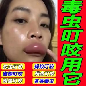 蜜蜂蛰了可以用什么药（蜜蜂蛰了可以用什么药膏消肿止痒）-图2