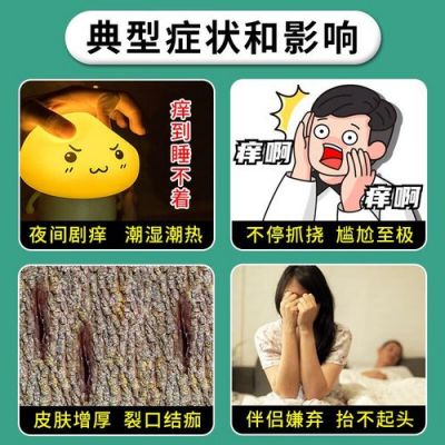 阳囊湿疹用什么药（阴囊湿疹专用药）-图3