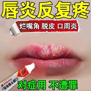 口周皮炎用什么药（口周皮炎用什么药有效）-图2