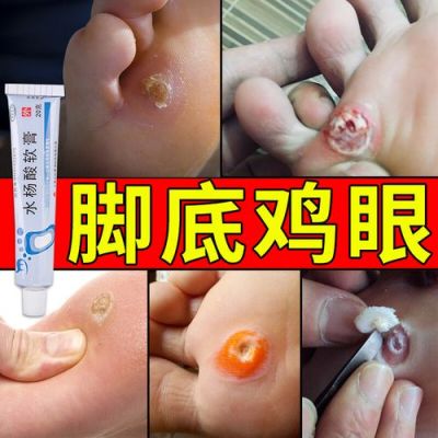 鸡眼用什么药治（鸡眼用什么药治能彻底根除）-图1