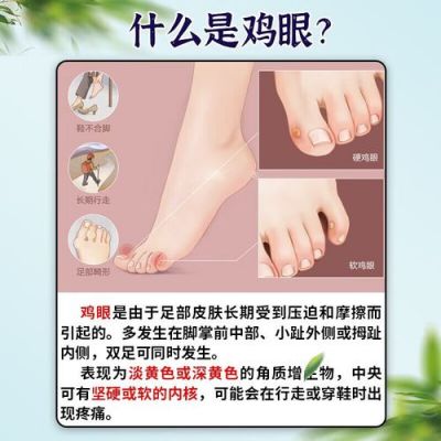 鸡眼用什么药治（鸡眼用什么药治能彻底根除）-图3