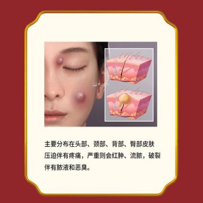 皮腺囊肿用什么药（皮腺囊肿用什么药膏）-图3