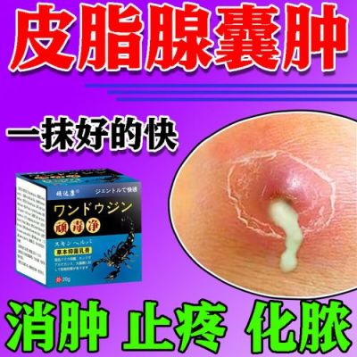 皮腺囊肿用什么药（皮腺囊肿用什么药膏）-图2