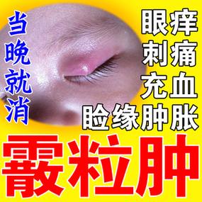 5岁眼睛红肿擦什么药（5岁孩子眼睛红肿痒怎么回事怎么治疗）-图1