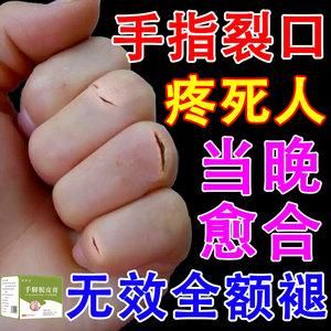 手指砸伤用什么药（手指砸伤用什么药比较好）-图1